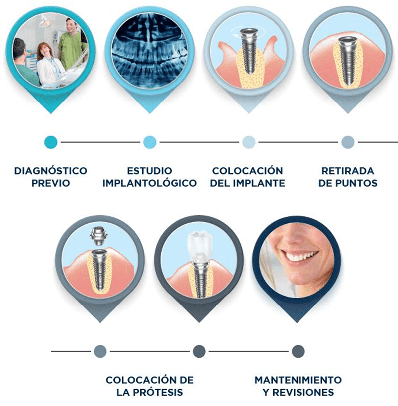 Pasos implantes | Integramedica