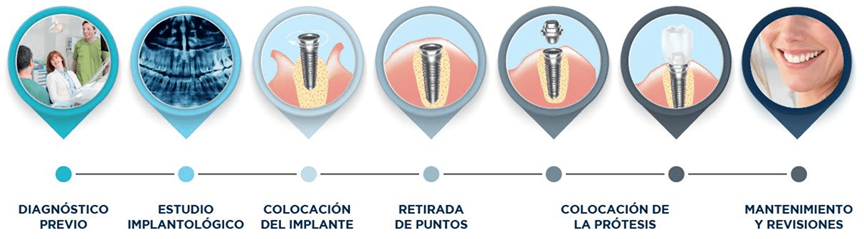 Pasos implantes | Integramedica