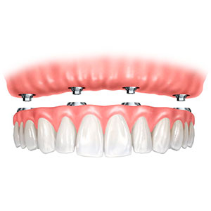 Prótesis fija total sobre implantes (admodum) | Integramedica