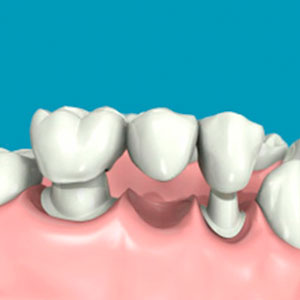 Prótesis dental fija | Integramedica