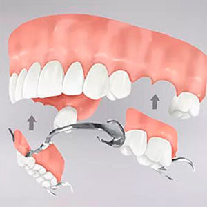 Prótesis dental removible | Integramedica