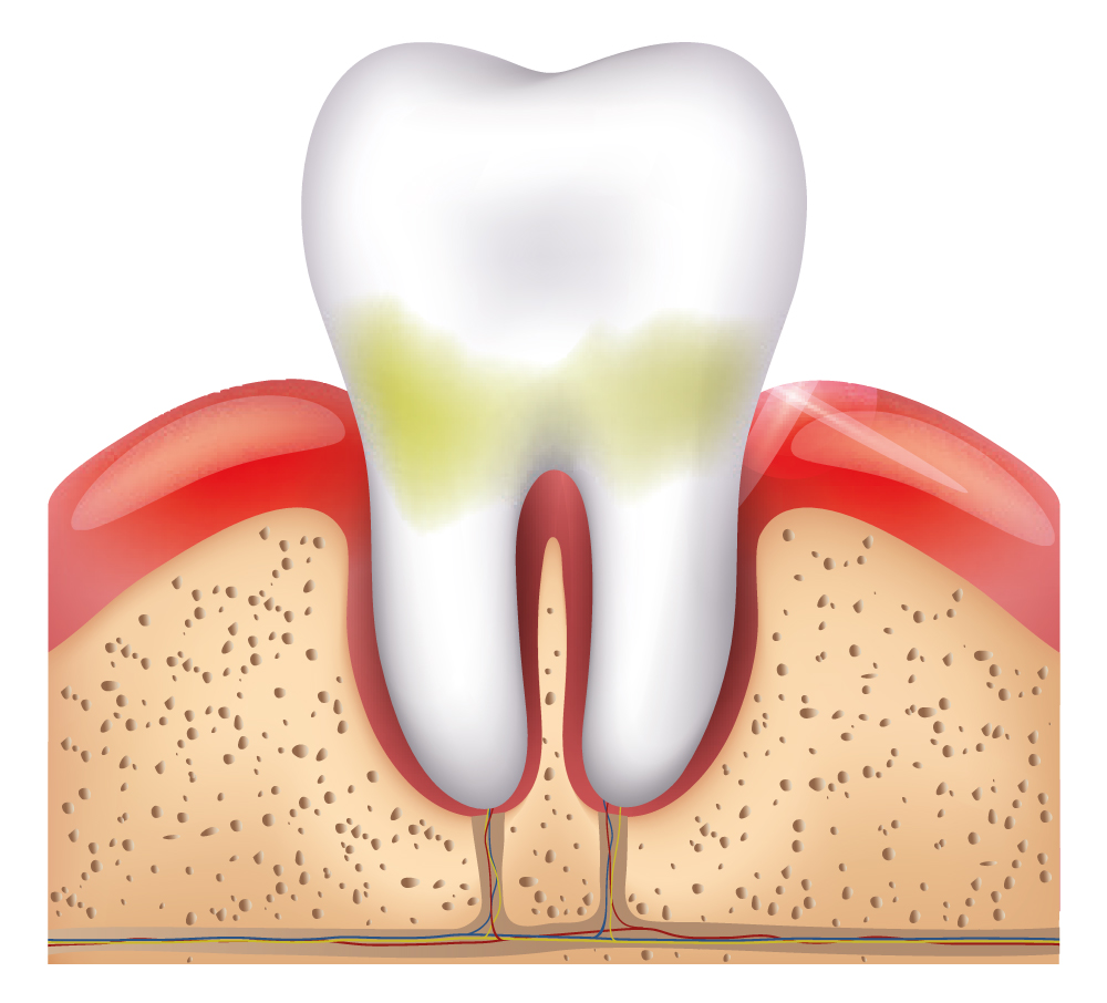 Gingivitis