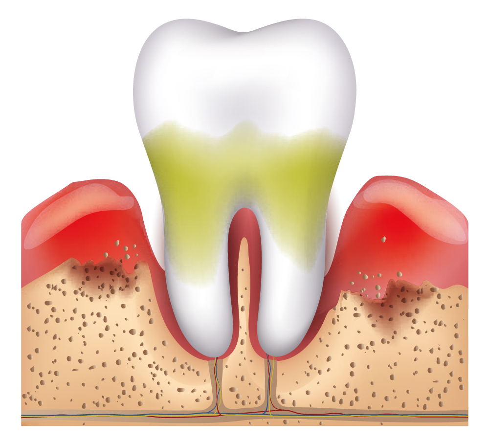 Periodontitis avanzada