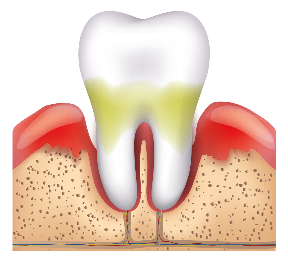 Periodontitis