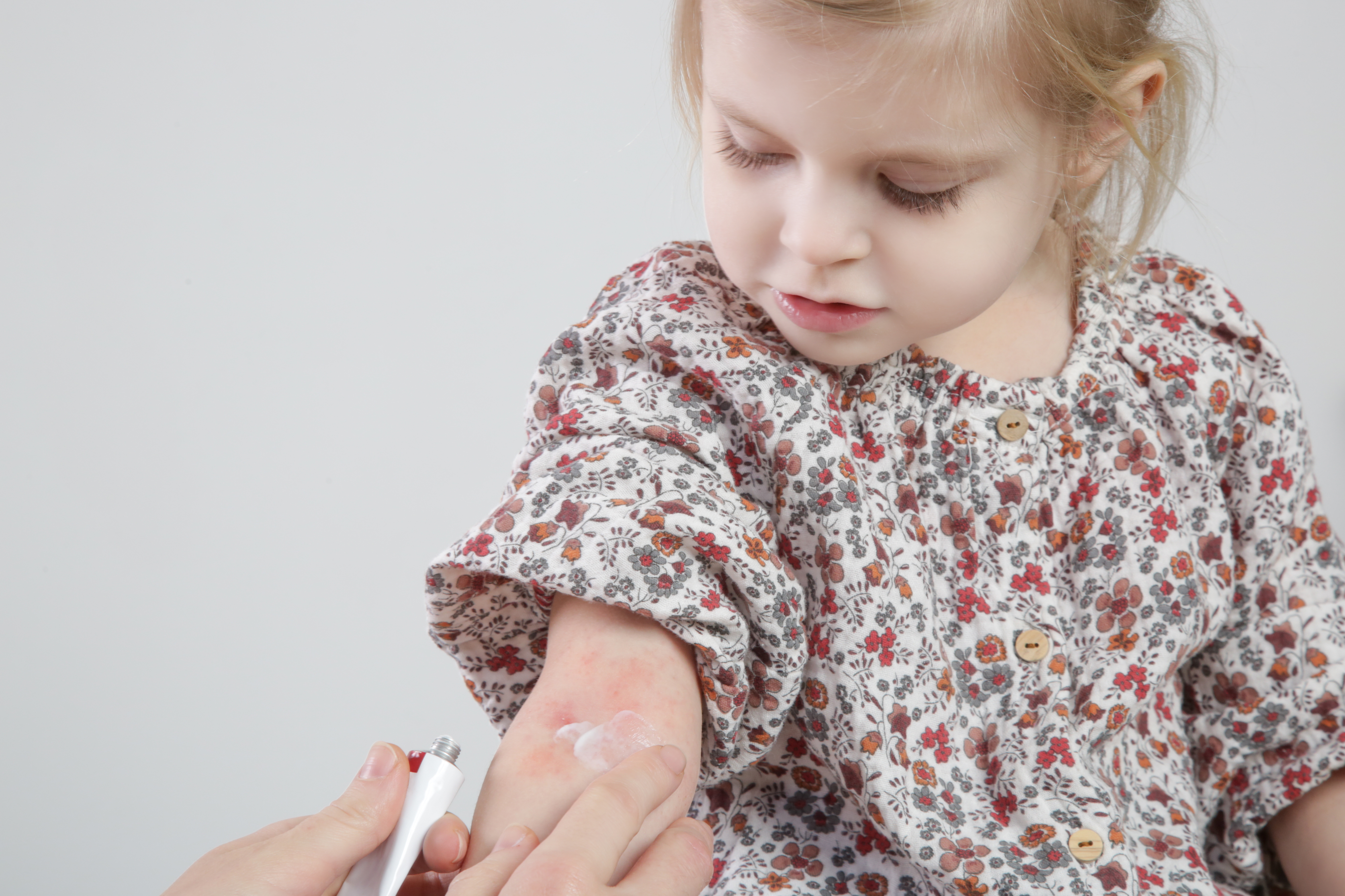 Síntomas de alergias en la piel en niños