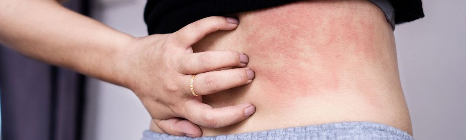 Alergias y erupciones cutáneas: ¿Cómo prevenirlas?