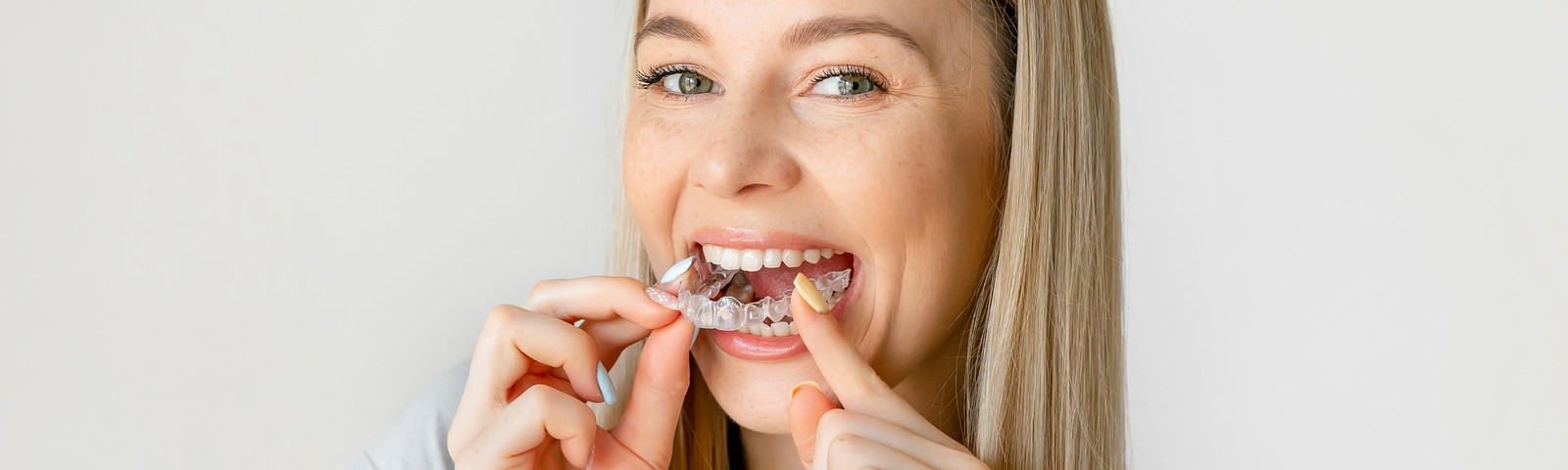 Tipos de ortodoncia: lo que necesitas saber antes de iniciar tu tratamiento