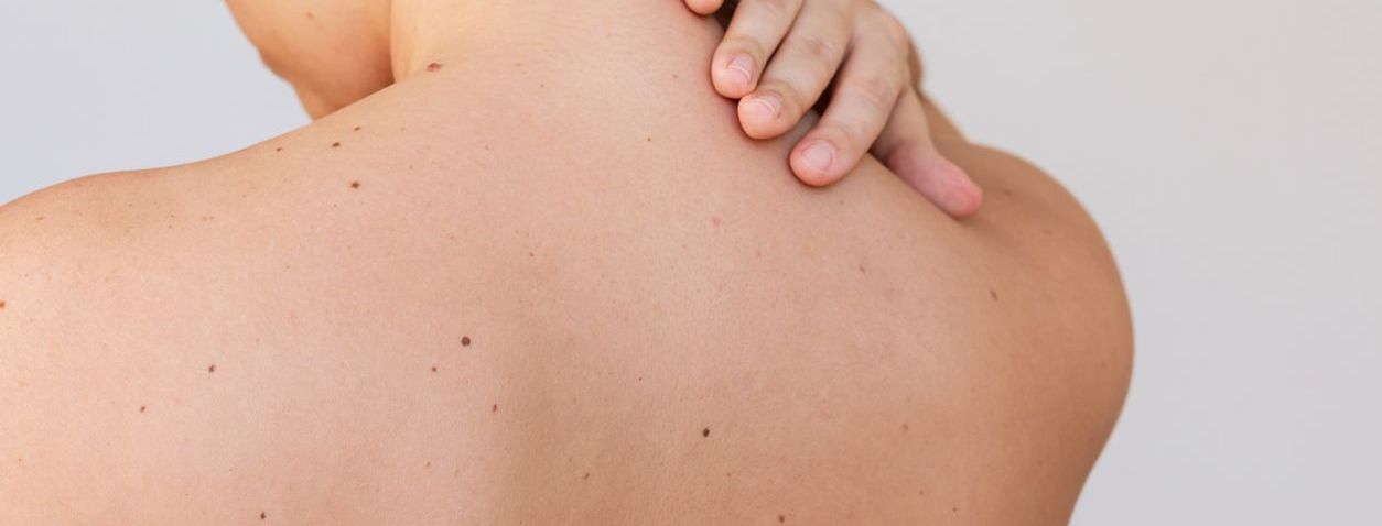 Lunares y pecas: diferencias, cuidados y cuándo preocuparse