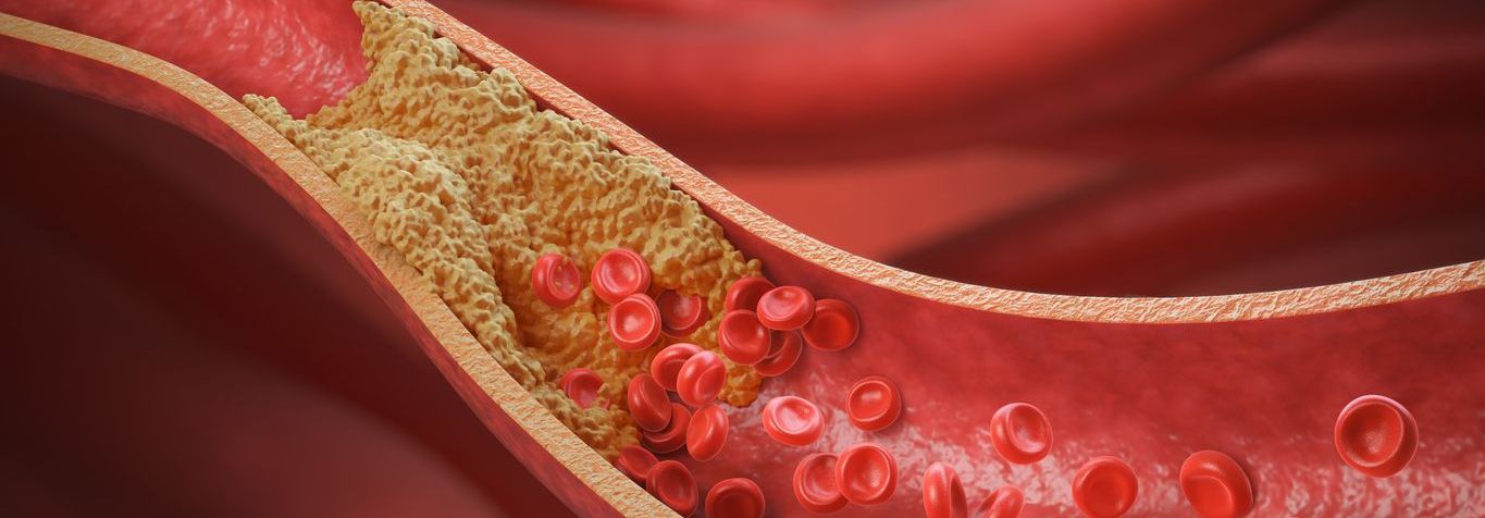 Exceso de colesterol: síntomas, causas y cómo bajarlo