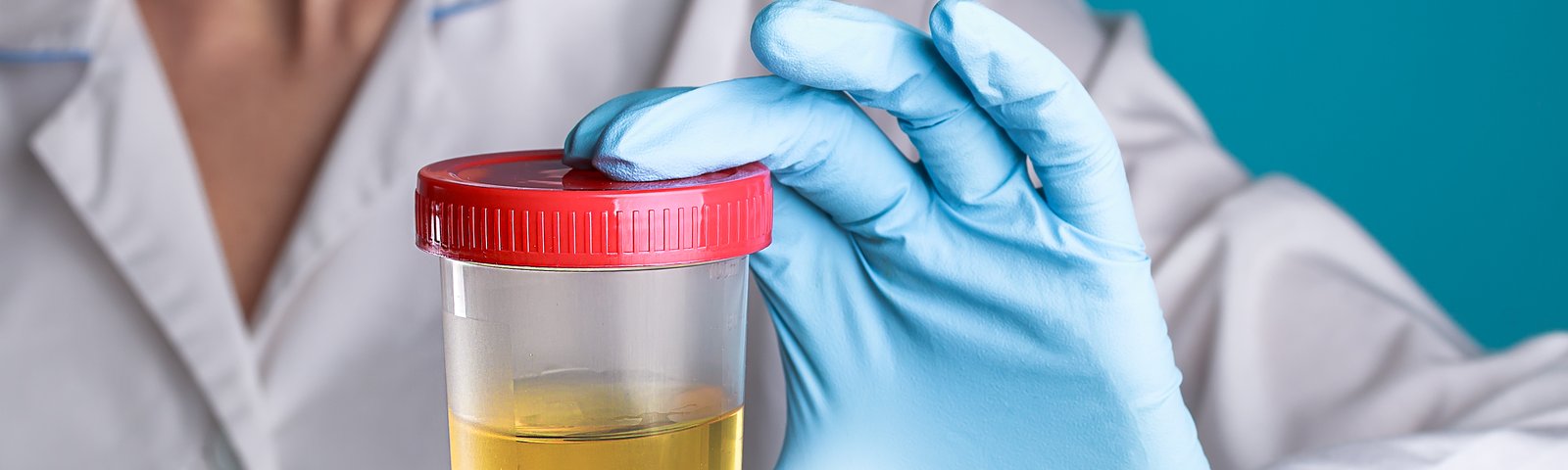 Urocultivo: ¿Qué es y cómo se realiza?