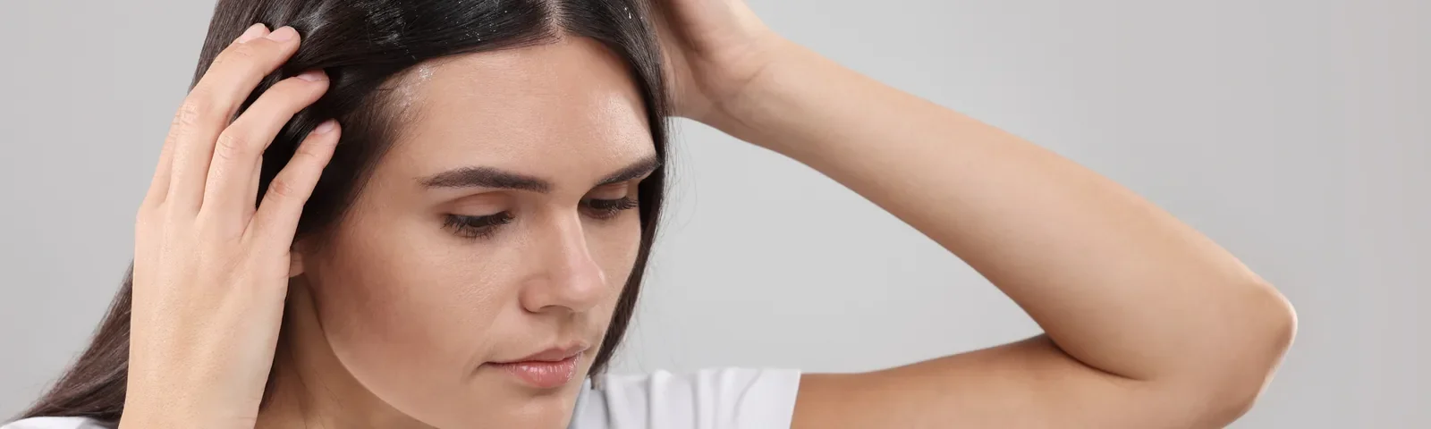 Dermatitis seborreica: síntomas, causas y cómo tratarla