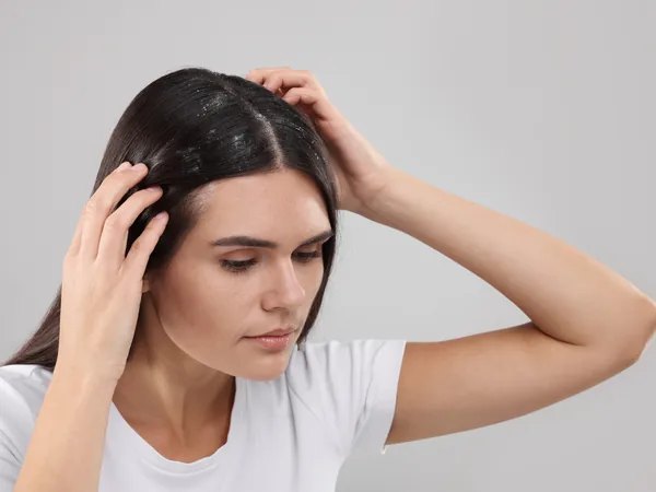 Mujer revisándose el cuero cabelludo con descamación por dermatitis seborreica